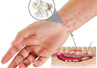 Manifestations of subcutaneous parasites in humans