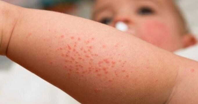 Skin rash as a symptom of parasitic infection